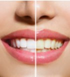 ציפויי קומפוזיט: הדרך הקלה לשיניים מושלמות-תמונה